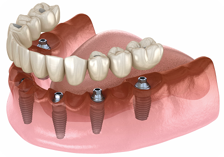 All on X (Full Arch Implant)